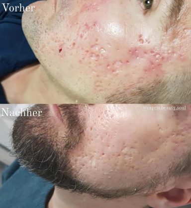 Mikroneedling nach 7 Behandlungen