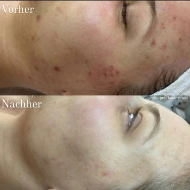 Mikroneedling nach 3 Behandlungen