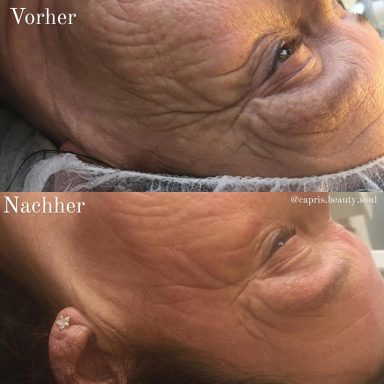 Mikroneedling nach 5 Behandlungen